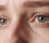Low-cost HIV drug to improve vision in patients with common diabetes complication