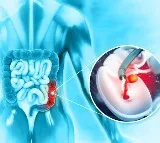 Bowel Cancer Silent Killer in Youth