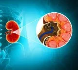 Facts about Kidney stones