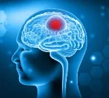 Brain Tumor Early Detection Tips and Symptoms