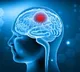 Brain Tumor Early Detection Tips and Symptoms