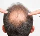 Salman Delhiwala Hair Growth Scam Busted in Hyderabad Old City