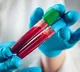 Deadly blood cancer can now be detected early with blood test: Study