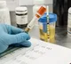Uric Acid Linked to Heart Attack Risk