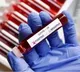 ICMR AIIMS reveal reasons for post Covid deaths