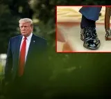 Trump diagnosed with chronic venous insufficiency