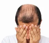 Home Remedies for Alopecia and Hair Loss