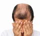 Home Remedies for Alopecia and Hair Loss