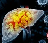 Jaundice Causes Symptoms and Prevention Tips
