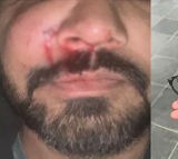 Indian Origin Mans Face Fractured In Unprovoked Racist Attack In Ireland