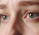 Corneal Blindness in Teenagers a Serious Warning from Experts