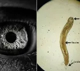 Worm In Eye Leaves Indian Man With Blurred Vision US Study Finds