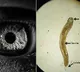 Worm In Eye Leaves Indian Man With Blurred Vision US Study Finds