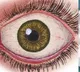 Heart Attack Symptoms Can Be Detected Early with Eye Exam