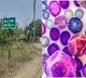 Melioidosis scare in Chebrolu Mandal after death in Kotha Reddypalem
