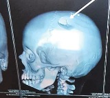 Teacher Hits Student on Head in Chittoor Skull Fractured