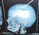 Teacher Hits Student on Head in Chittoor Skull Fractured