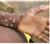 Mpox cases in Africa surpass 190,000, deaths near 2,000: Africa CDC