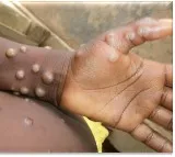 Mpox cases in Africa surpass 190,000, deaths near 2,000: Africa CDC