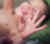 Tomato Virus Outbreak in Madhya Pradesh Affects Children