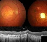 PRIMA Gives Sight to the Blind New Technology Creates Miracle