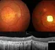 PRIMA Gives Sight to the Blind New Technology Creates Miracle