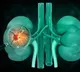 Chronic Kidney Disease Haunts Hyderabad Youth No Diabetes BP Needed