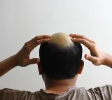 Hair Regrowth Serum in 20 Days Truth Behind the Claim