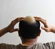 Hair Regrowth Serum in 20 Days Truth Behind the Claim