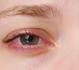 City doctors report 50 pc rise in eye problems as smog continues to engulf Delhi