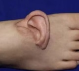 Medical Miracle Suns Ear Grown on Foot and Reattached