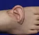 Medical Miracle Suns Ear Grown on Foot and Reattached