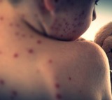 US reports over 2,000 measles cases in 2025, highest since 1992