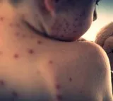 US reports over 2,000 measles cases in 2025, highest since 1992