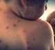 US reports over 2,000 measles cases in 2025, highest since 1992