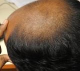 Woman Files Police Complaint Against Husband Over Baldness and Dowry