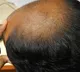 Woman Files Police Complaint Against Husband Over Baldness and Dowry