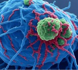 AIIMS Delhi doctors remove 19.9 kg tumour from 42-year-old colon cancer patient