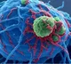 AIIMS Delhi doctors remove 19.9 kg tumour from 42-year-old colon cancer patient