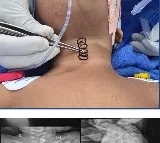 AIIMS doctors remove 2-inch-long metal spring from 14-month-old's food pipe