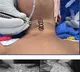 AIIMS doctors remove 2-inch-long metal spring from 14-month-old's food pipe