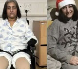 Manjit Sangha loses limbs after dog lick infection