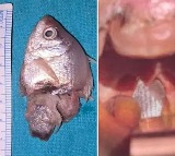 Indore Baby Saved After Aquarium Fish Gets Stuck in Throat