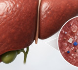 Plastic particles may trigger liver disease risk: Researchers