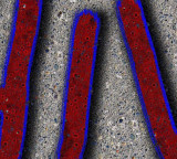 Concerns raised over rise in HIV cases at Pakistan Institute of Medical Sciences