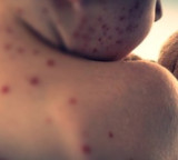 Bangladesh measles outbreak: Four more children die; toll rises to 280