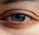 Eye Stroke What You Need to Know About Symptoms and Risks