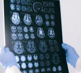 Magic Mushrooms result in recovery after five years of memory loss