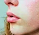 Heat Rash Home Remedies Found In Your Refrigerator To Treat Itching And Redness