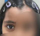 KIMS Kurnool Performs Complex Eye Reconstruction on Injured Six-Year-Old Girl